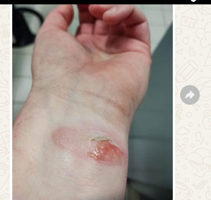 Coupe-feu – soulagement des brûlures