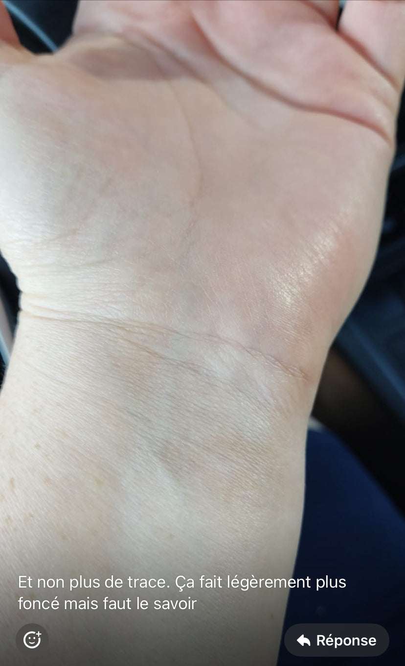 Coupe-feu – soulagement des brûlures